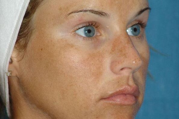 Age spots as an indication of fractional rejuvenation