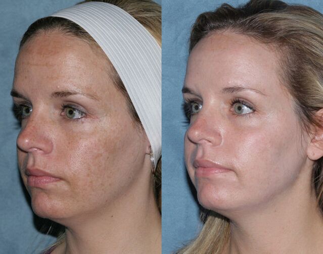 before and after fractional laser rejuvenation