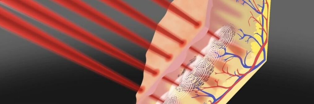Field rejuvenation of the skin