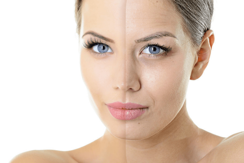 Rejuvenation of the face