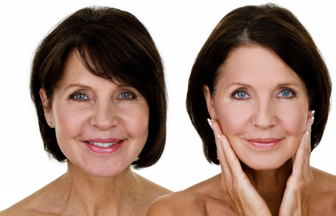 Rejuvenation of the skin of the face