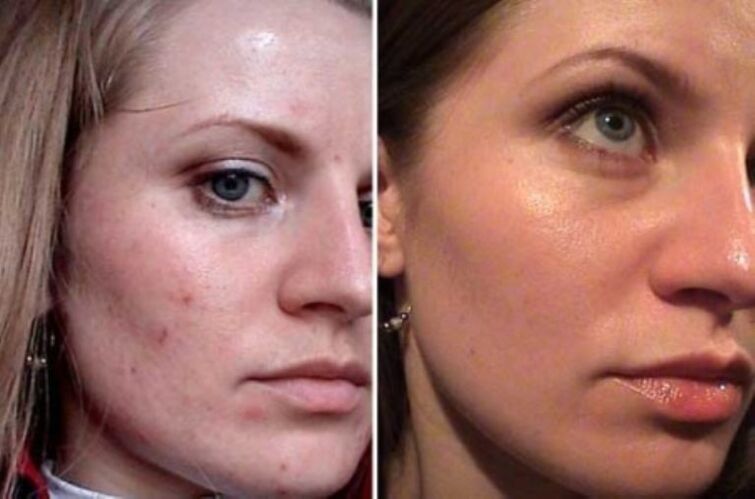 Correction of skin quality