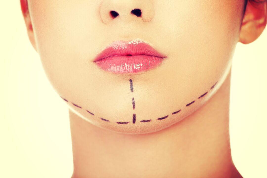 Marking on the face for laser lipolysis