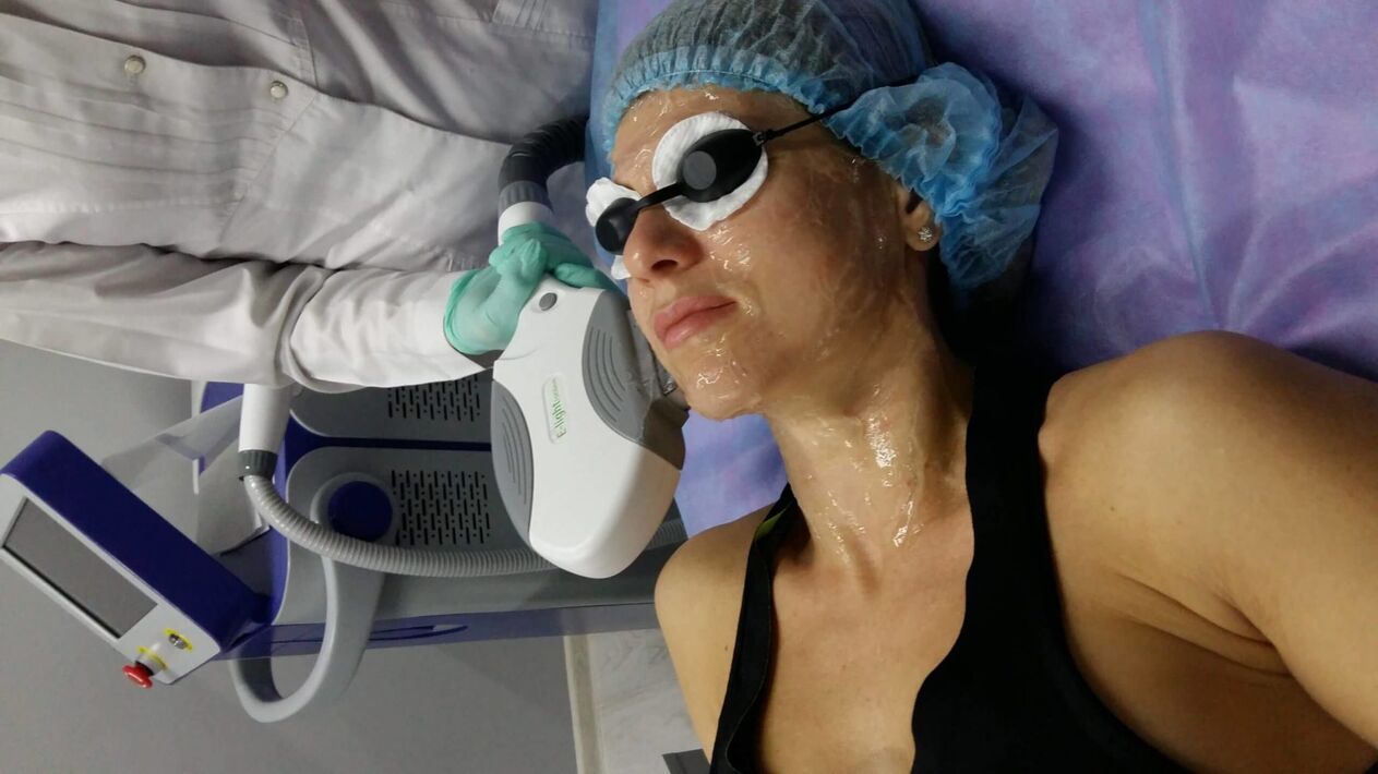 The use of a laser along with a gel for gentle skin rejuvenation