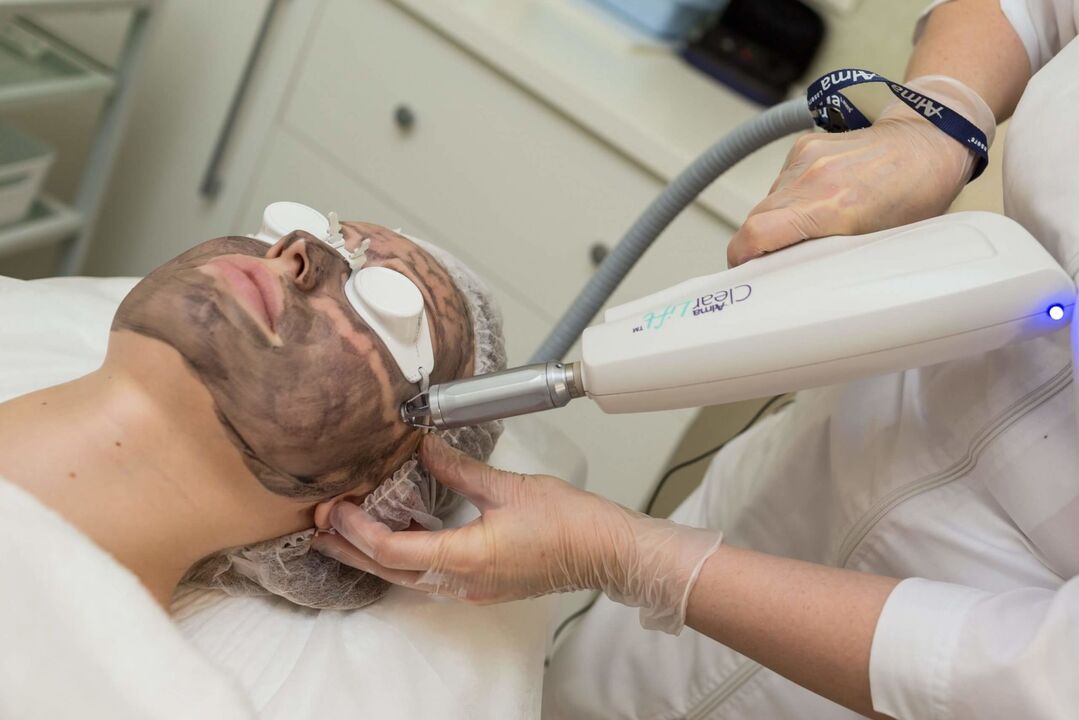 facial laser peeling