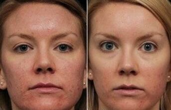 Laser rejuvenation of the face before and after