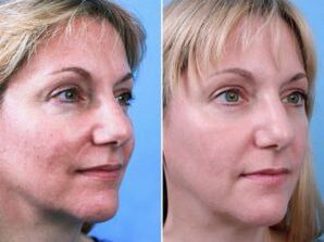 Photos before and after fractional skin rejuvenation