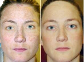 Skin care rules after fractional rejuvenation