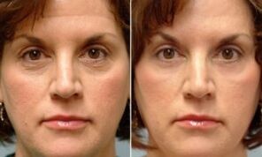 before and after fractional rejuvenation