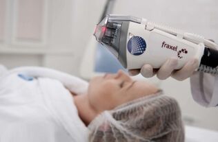 Fractional laser rejuvenation machine