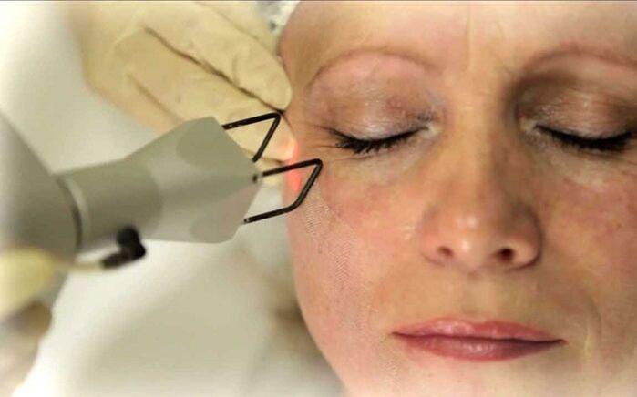 Laser removal of wrinkles around the eyes