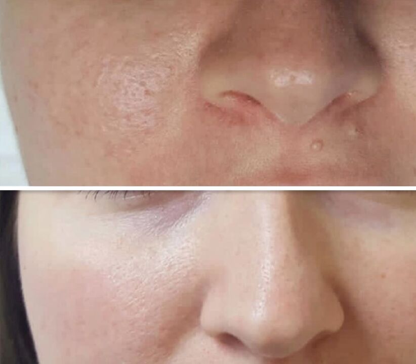 The result of fractional rejuvenation – facial skin before and after the procedure